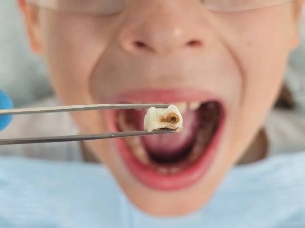 Best Emergency Broken Tooth Repair in Mckinney, TX